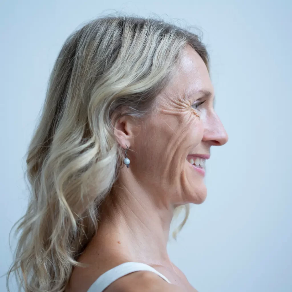 Marionette Smile Lines