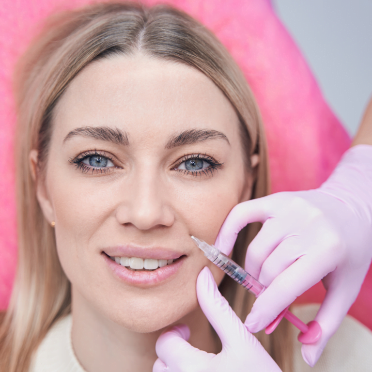 Marionette Smile Lines2