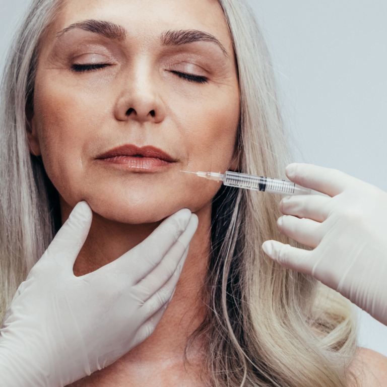 Marionette Smile Lines3